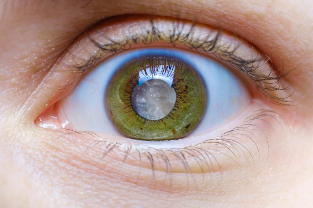 glaucoma treatment